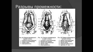 Акушерство и гинекология. Основные осложнения в родах