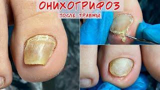 Onychogryphosis / Thick toenail