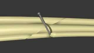 Fracture Fixation:  Lag Screw