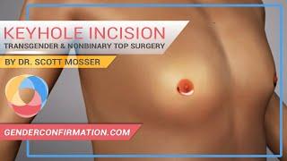 Transgender & Non-binary Keyhole Incision Top Surgery by Dr. Scott Mosser