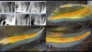 Upper first molar cleared specimen after failed RCT. 4K