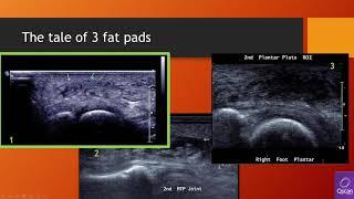 Forefoot ultrasound Pathology (Lecture with live scan MTP web space)