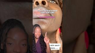 Your Acne won’t clear up because you have a Damaged Skin Barrier!