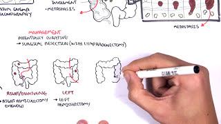 Colorectal Cancer - Overview