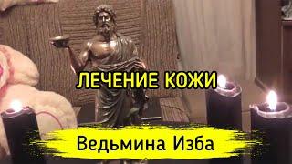 ЛЕЧЕНИЕ КОЖИ. ДЛЯ ВСЕХ ▶️ ВЕДЬМИНА ИЗБА - МАГИЯ