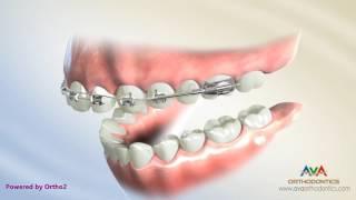 Orthodontic Treatment for Overjet (Overbite) - Wilson Bimetric Distalizing Arch Appliance