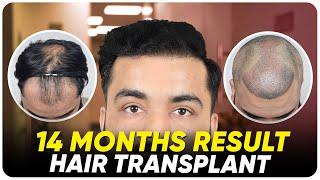 Hair Transplant in Turkey | Best Results & Cost of Hair Transplant in Turkey