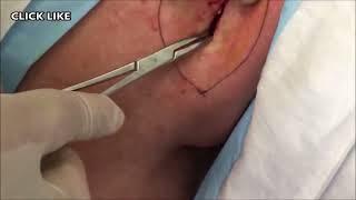 Classic Popping!  Dr. John Gilmore Removal Procedure   Meta Seven