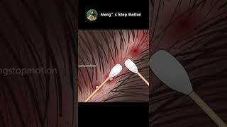 ASMR Itchy scalp and head acne? Stress-relieving scalp treatment