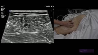 Hamstring Ultrasound of the  Semimembranosus and Semitendinosus