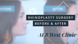 Rhinoplasty Transformations - Before & After Pictures, 8 West Clinic | Dr. Buonassisi in Vancouver