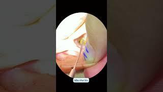 Earwax removal part 74