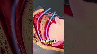 Causes And Treatment Of Snoring {3D Animation)  #sleepapneaawareness #Snoring