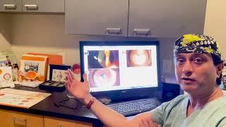 Do Intacs Work for Keratoconus?