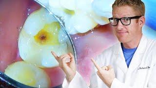 Dentist Filling a Cavity Step by Step! With Decay Removal and a Class 1 White Composite Resin
