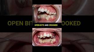 Braces super crooked and openbite teeth #braces #orthodontist #dentist