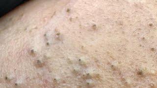 I Tested SENSITIVE SKIN Pimple Care Solutions That REALLY Work!
