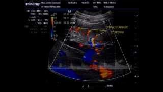 Дуплексная и триплексная допплерография почечных сосудов