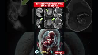 Baby's Twin Discovered Growing Inside Her Brain | Rare Case: Baby's Twin Develops Inside Her Skull