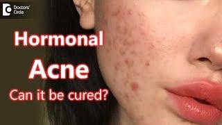 Can Hormonal Acne be cured? - Dr. Rasya Dixit