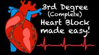 EMS Cardiology || Tachy Tuesday: 3rd Degree Heart Block (Complete Heart Block) in EMS