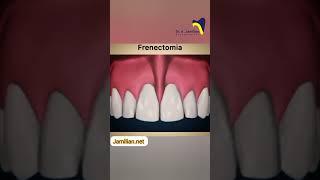 Frenectomy and diastema #dentist #bracing #orthodontics