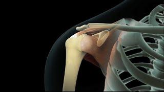 Rotator Cuff Shoulder Surgery