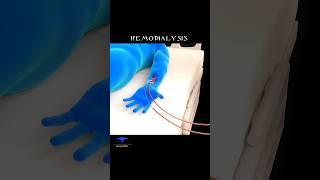 Artificial Kidney (Hemodialysis) Animated video ' #shorts