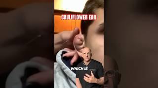 Dead Cartilage or Mark of Distinction⁉️ Cauliflower Ear #shorts