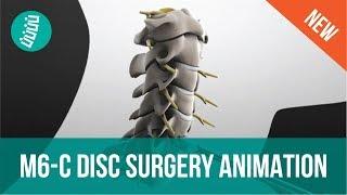 M6-C Artificial Disc Replacement (ADR): Surgery Animation