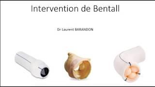 Votre opération du coeur: l'intervention de Bentall pour anévrisme de la racine de l'aorte