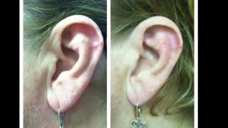 ScarWork for ear cartilage