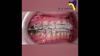 How Ceramic Braces Correct Crowded Teeth | Orthodontic Treatment Explained #ceramic #orthodontics