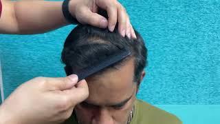 Natural Hairline Results | Best Hair Transplant Results | Dr Jangid | New Delhi