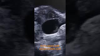 Early pregnancy#ultrasound #imaging #medicine #medicalimaging #viral