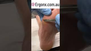 Callus cutting in podiatry clinic we remove callus for comfort and to prevent cracking and