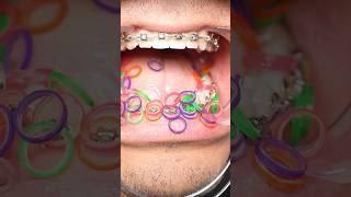 Dentist Reveals The BEST and WORST Elastic Colours For Your Teeth! 