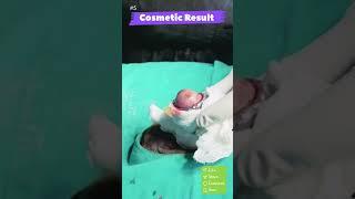 Circumcision Surgery Benefits | Enhanced Health and Wellness at Rejuvena Cosmo Care"