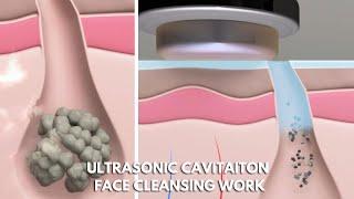 Ultrasonic Cavitation Face Cleaning | What Is Ultrasonic Cavitation Face Cleaner | myChway N7