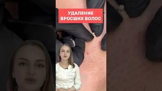 Как удаляют вросшие волосы? Как избавиться НАВСЕГДА?