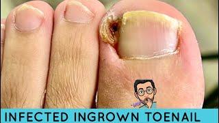EXTRACTION OF INFECTED INGROWN TOENAIL! **GNARLY ONE TOO