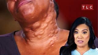 Years of Struggle – Can Dr. Lee End Nicole’s Pain? | Dr. Pimple Popper TLC