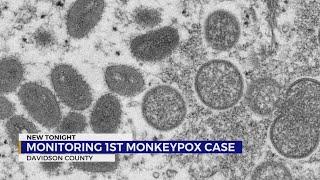 Metro Public Health Department confirms first monkeypox case in Tennessee