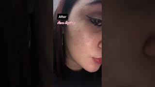 Before & After Results with SLMD Skincare