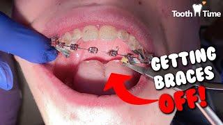 Dental Braces: How they take braces off - Tooth Time Family Dentistry New Braunfels