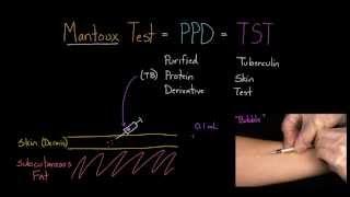 Mantoux Test (aka. PPD or TST)