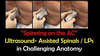 "Spinning on the AC" - US Imaging for Spinals & LPs in Challenging Anatomy