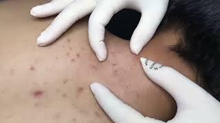 big Blackheads removal on back relaxing With Vu Quynh Mi Spa 2023  #001