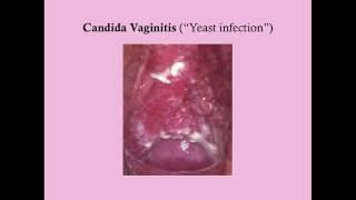 Infectious Vaginitis - CRASH! Medical Review Series