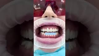 Before & After- Laser teeth whitening in 60 secs